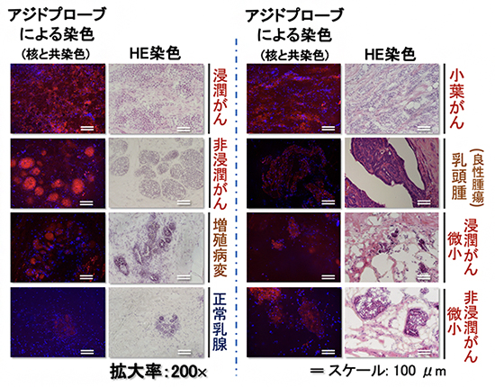 アジドプローブ染色とHE染色による乳がんの種類の比較結果の図